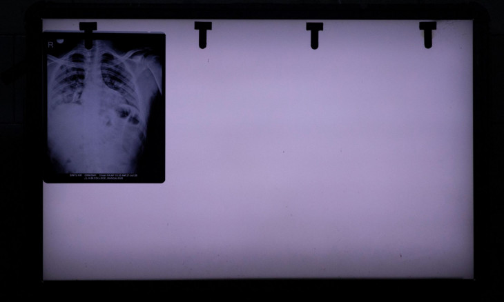 An X-ray picture taken from a patient 
