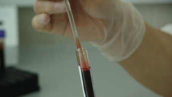 Leukemia