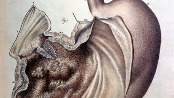 Stomach cancer illustration