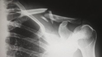 X-RAY