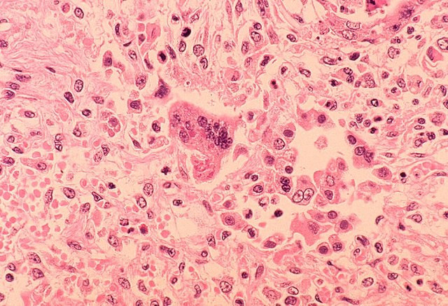 Vaccine Skepticism Fuels Measles Spread in Florida Schools, Criticism Mounts Over Florida's Response