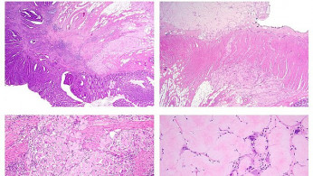 Rising Colon Cancer Rates Among Young Adults Highlight Need for Early Detection