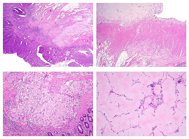 Rising Colon Cancer Rates Among Young Adults Highlight Need for Early Detection