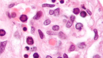 CDC Warns of Rising Parvovirus B19 Cases Amid U.S. Surge: What You Need to Know