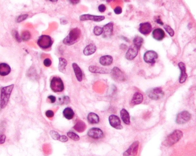 CDC Warns of Rising Parvovirus B19 Cases Amid U.S. Surge: What You Need to Know