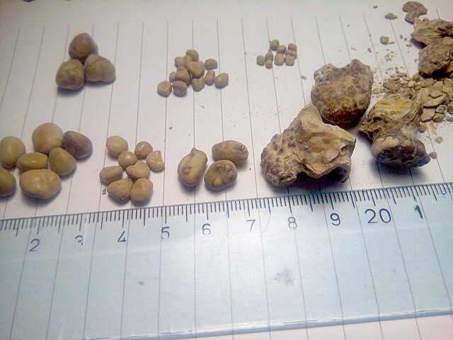 Kidney Stones Surge Among Children, Experts Point to Diet and Dehydration