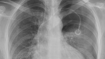 Lung Cancer Cases Rise Among Non-Smokers as Air Pollution Emerges as Key Risk Factor