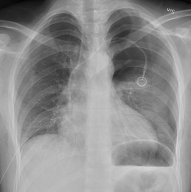 Lung Cancer Cases Rise Among Non-Smokers as Air Pollution Emerges as Key Risk Factor