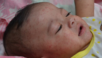 Vitamin A Toxicity Emerges in Texas Measles Outbreak as RFK Jr. Promotes Unproven Remedies
