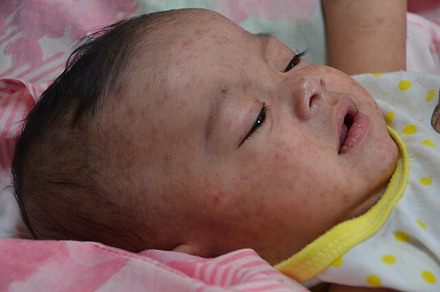 Vitamin A Toxicity Emerges in Texas Measles Outbreak as RFK Jr. Promotes Unproven Remedies
