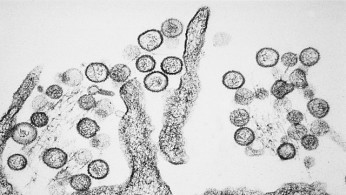 Rare Hantavirus Kills Third Person in California Town, Same Virus Linked to Gene Hackman’s Wife