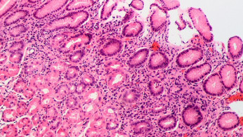 Global Study Finds 11.9 Million Stomach Cancer Cases Tied to H. pylori Infection, Prompting Calls for Mass Screening