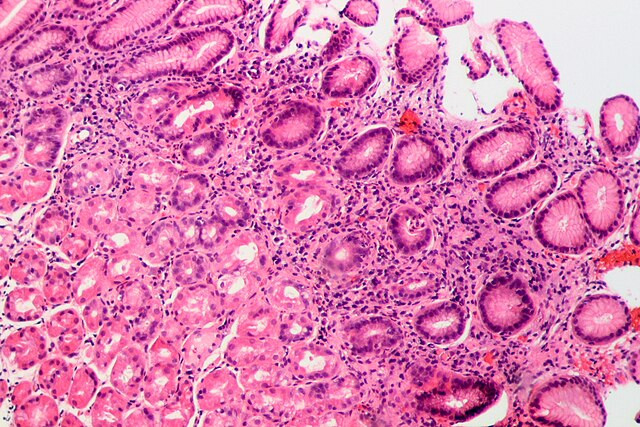 Global Study Finds 11.9 Million Stomach Cancer Cases Tied to H. pylori Infection, Prompting Calls for Mass Screening