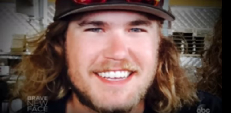 face transplant