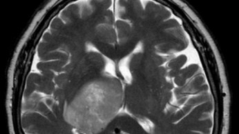 Glioblastoma 