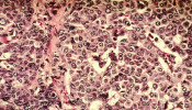 Breast Cancer Cells
