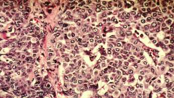 Breast Cancer Cells