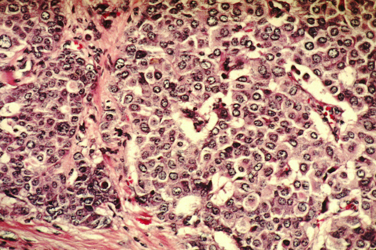 Breast Cancer Cells