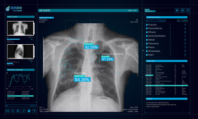 InferRead DR Chest