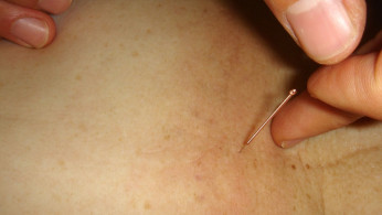 Acupuncture