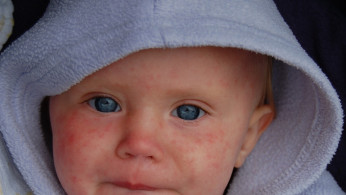 12 US States Confirmed To Have Measles Outbreak