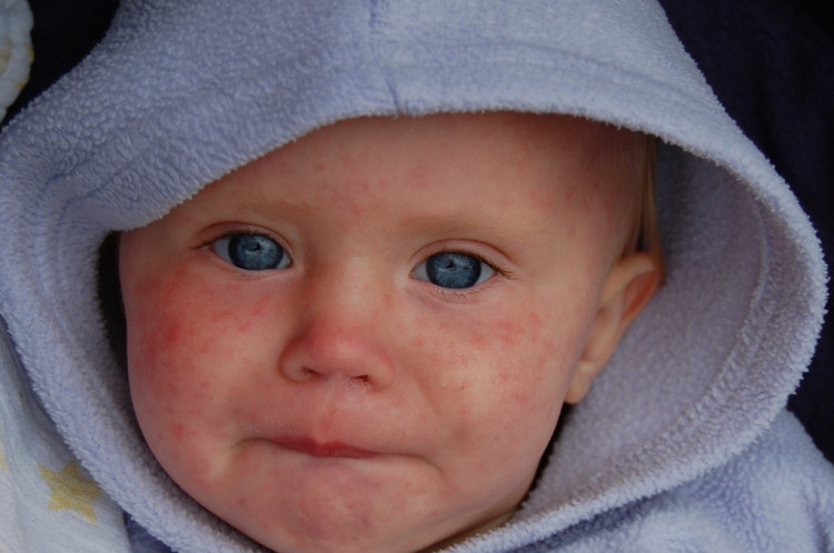 12 US States Confirmed To Have Measles Outbreak